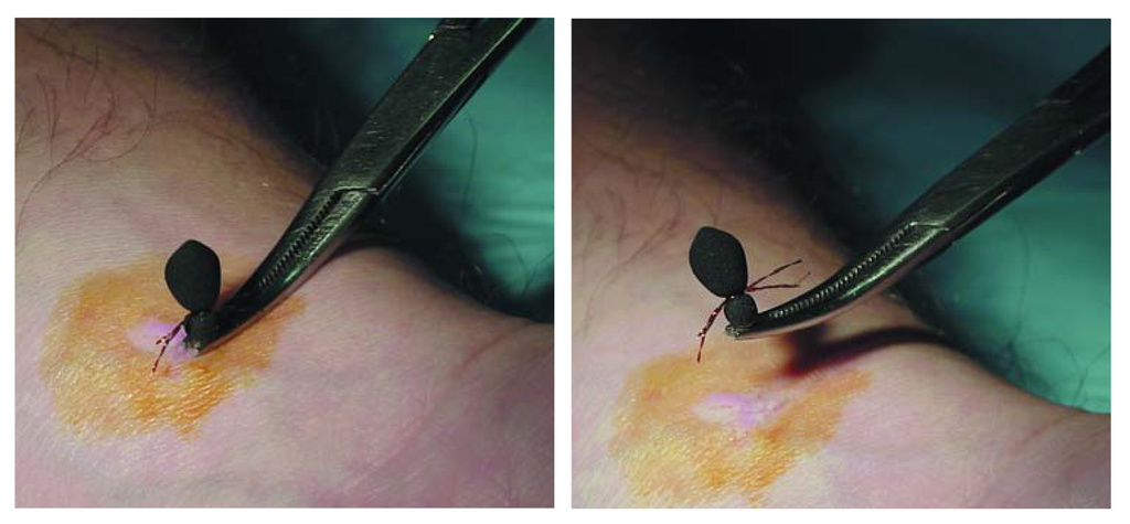 kleszcz_tick_removal_1024